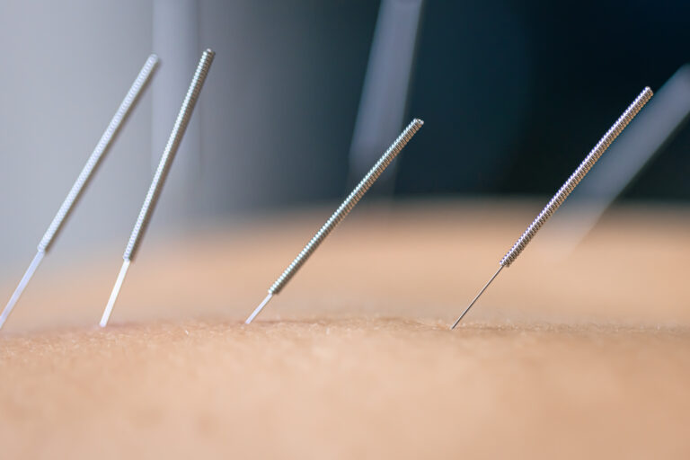Tratamientos de acupuntura en Madrid