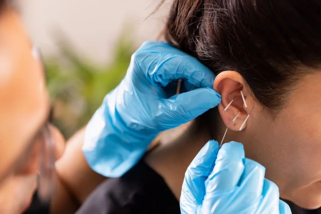 Primer plano de una oreja durante una sesión de auriculoterapia.
